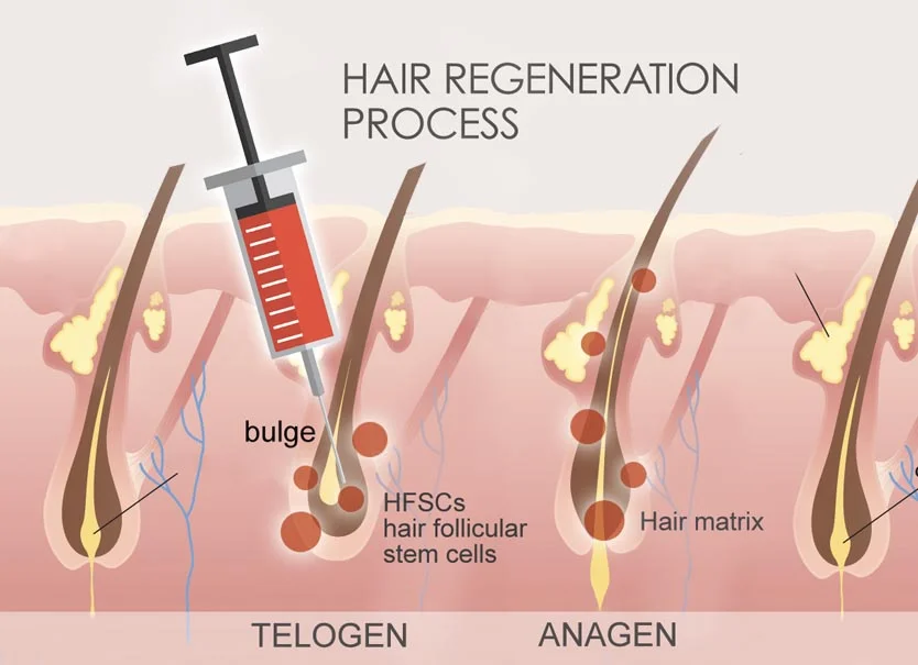 FUE / DHI with Stem Cells