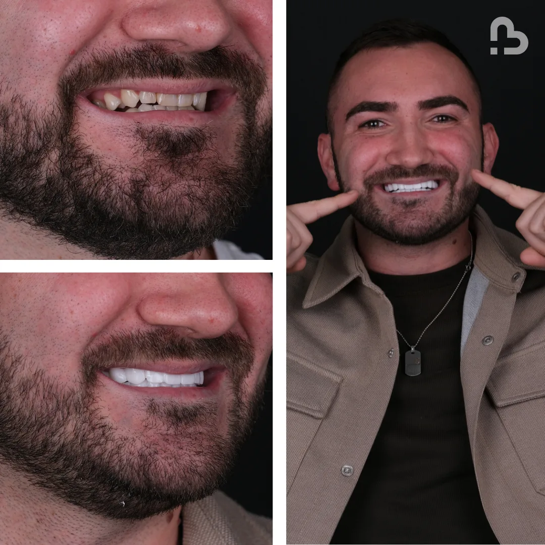 Before and after result 9