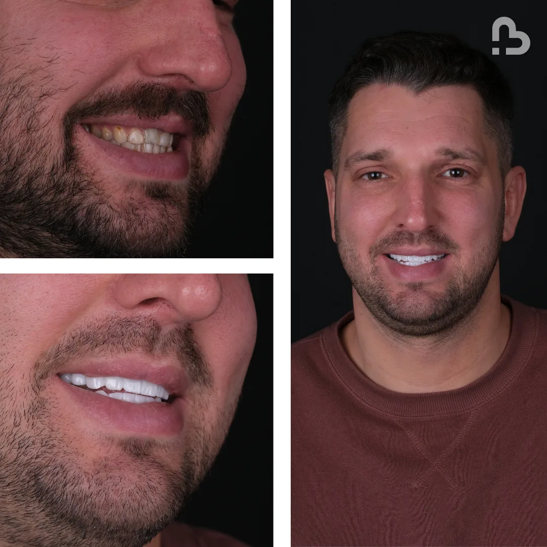 Before and after result 10