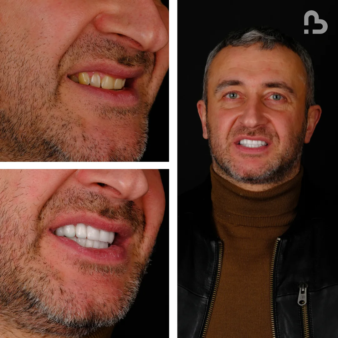 Before and after result 11