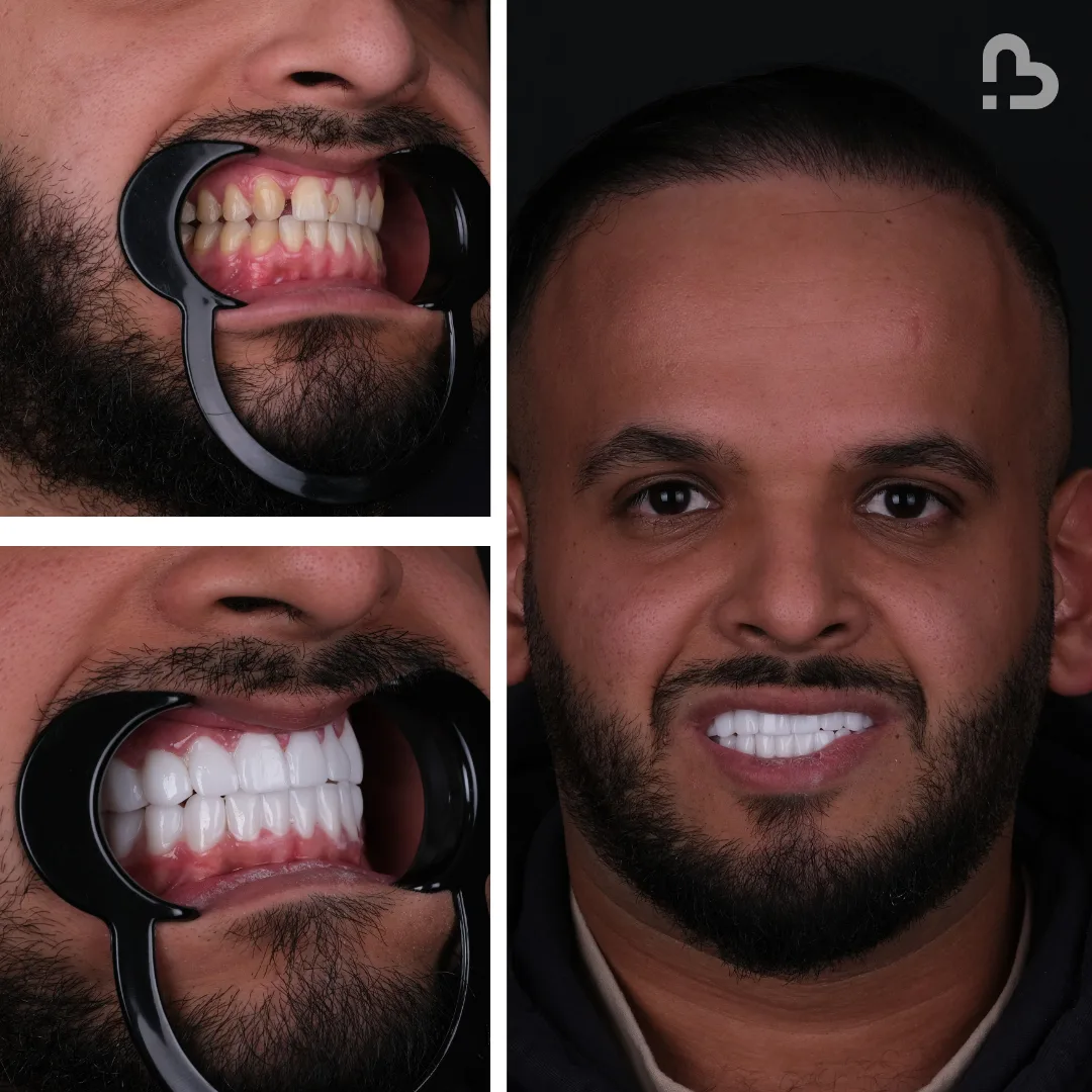 Before and after result 13