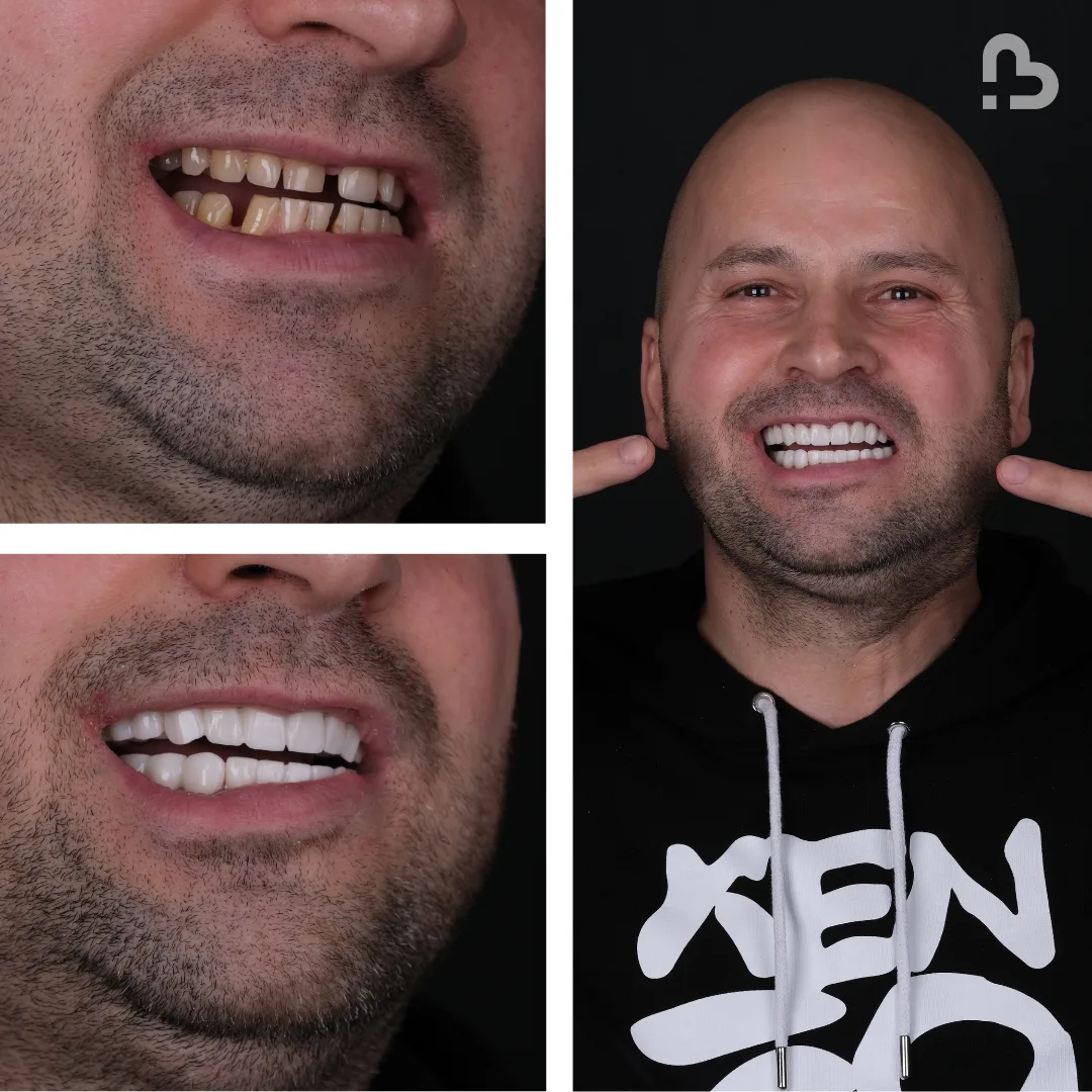 Before and after result 18
