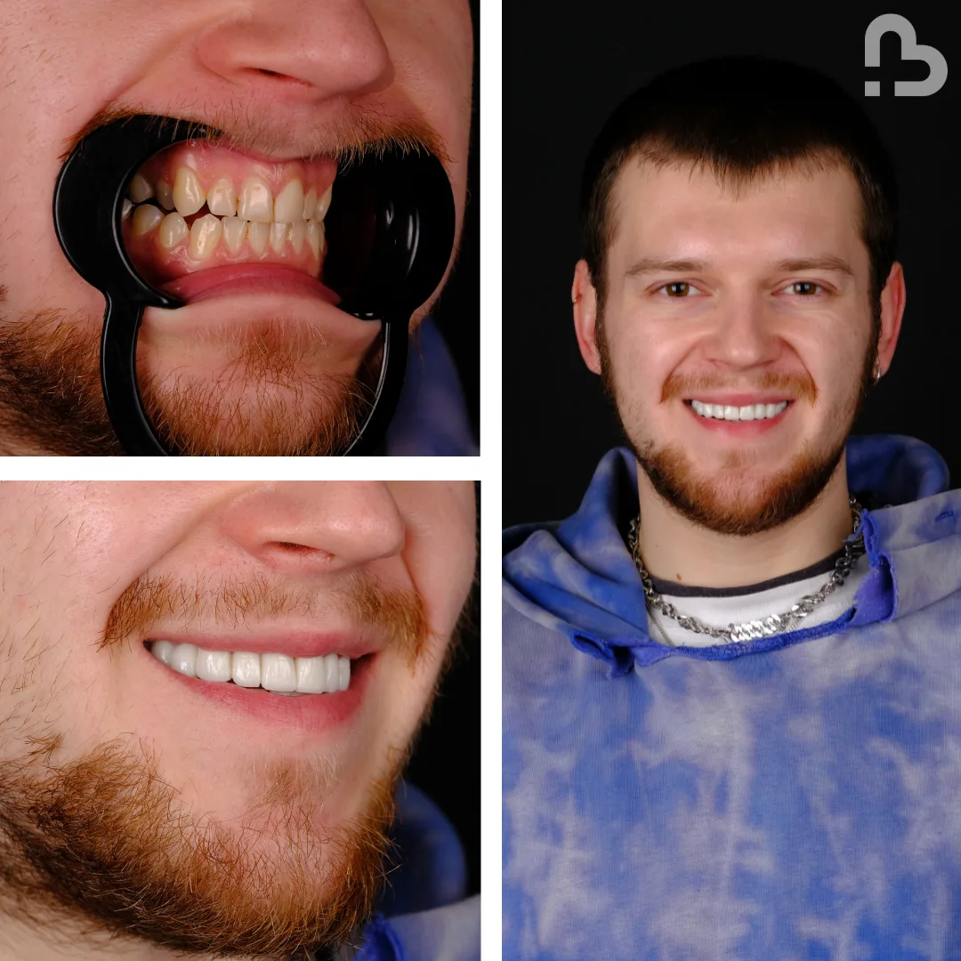 Before and after result 3