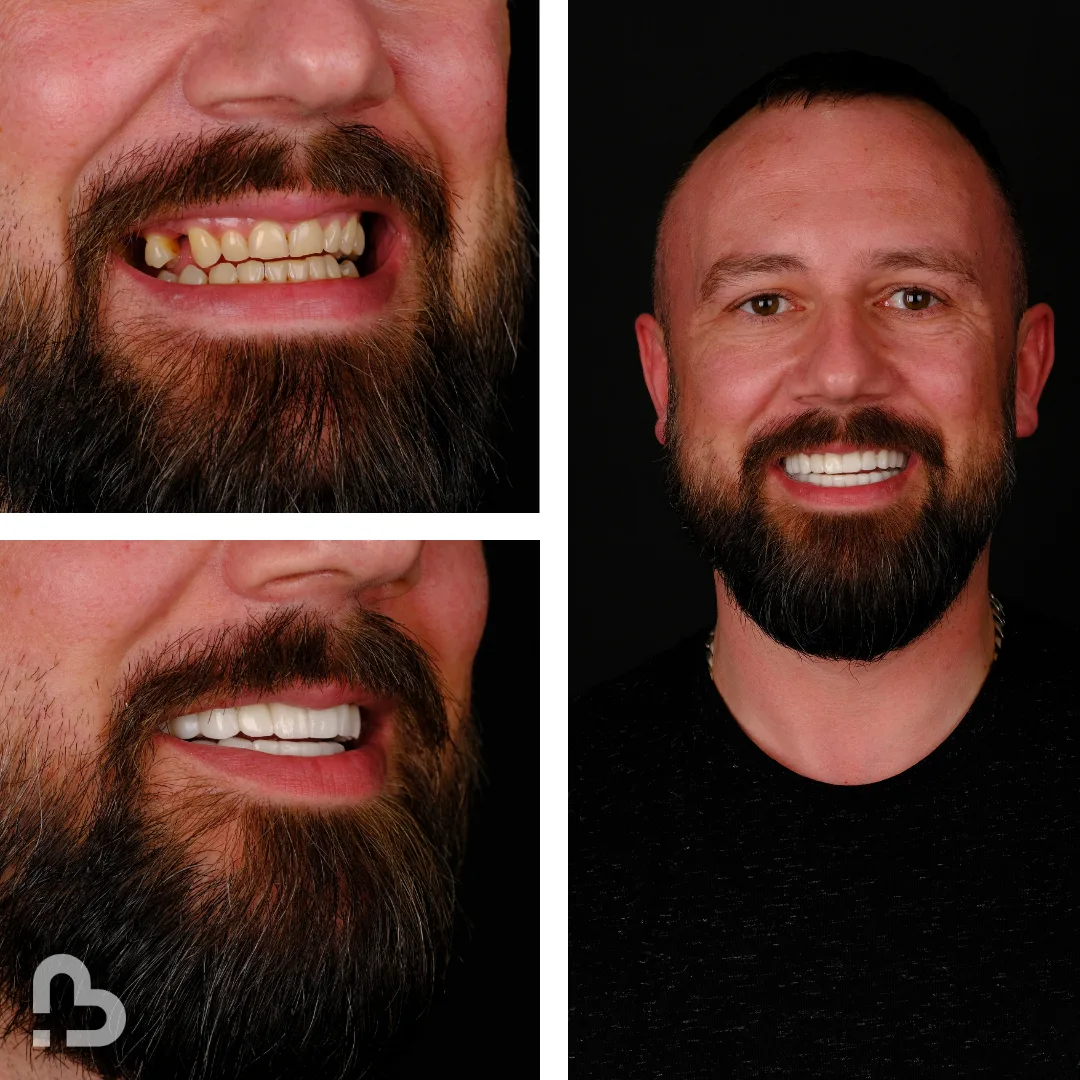 Before and after result 4