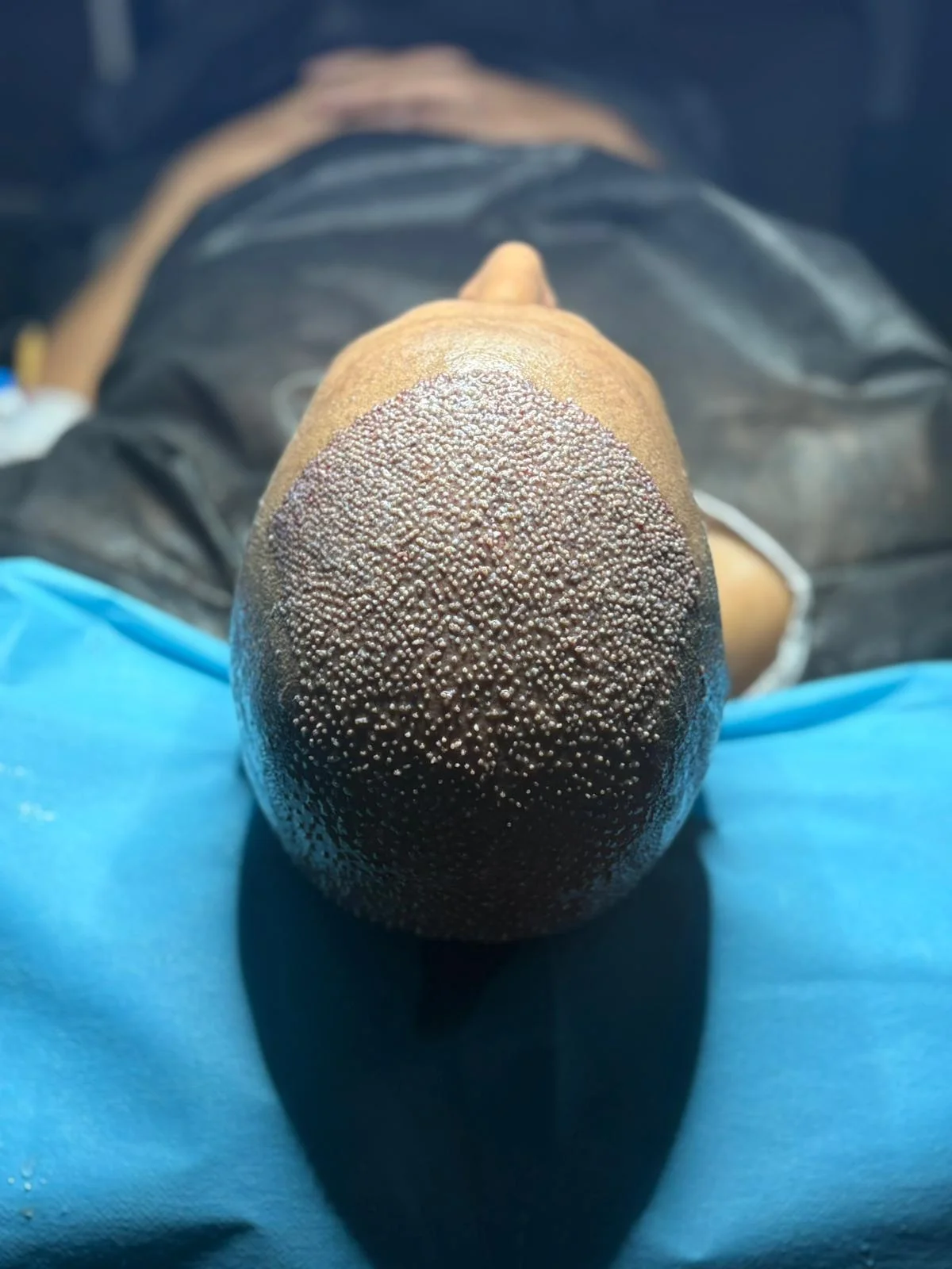 Best hair transplant package