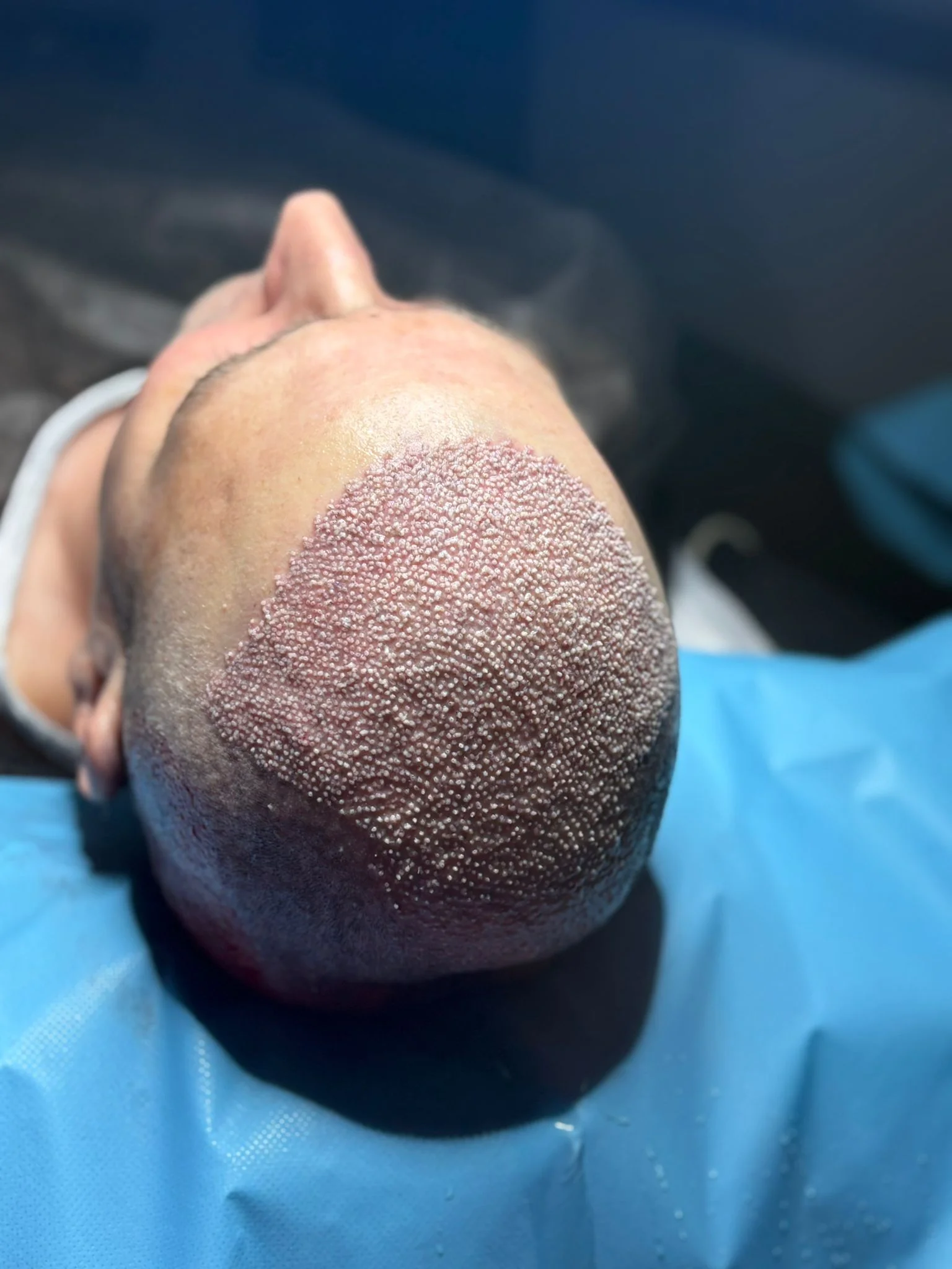 Full Hair Transplant hair transplant package