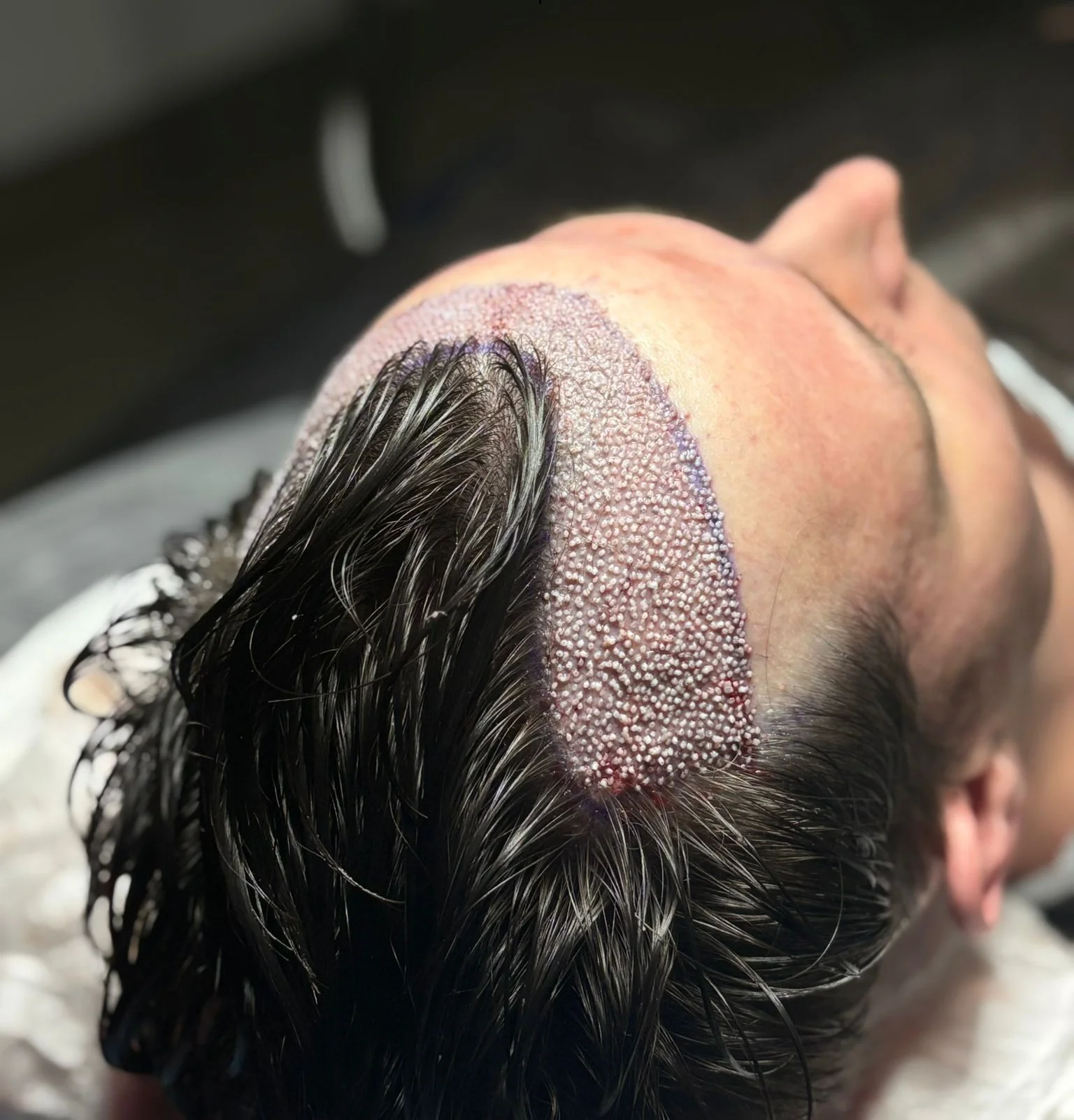 Hairline hair transplant package