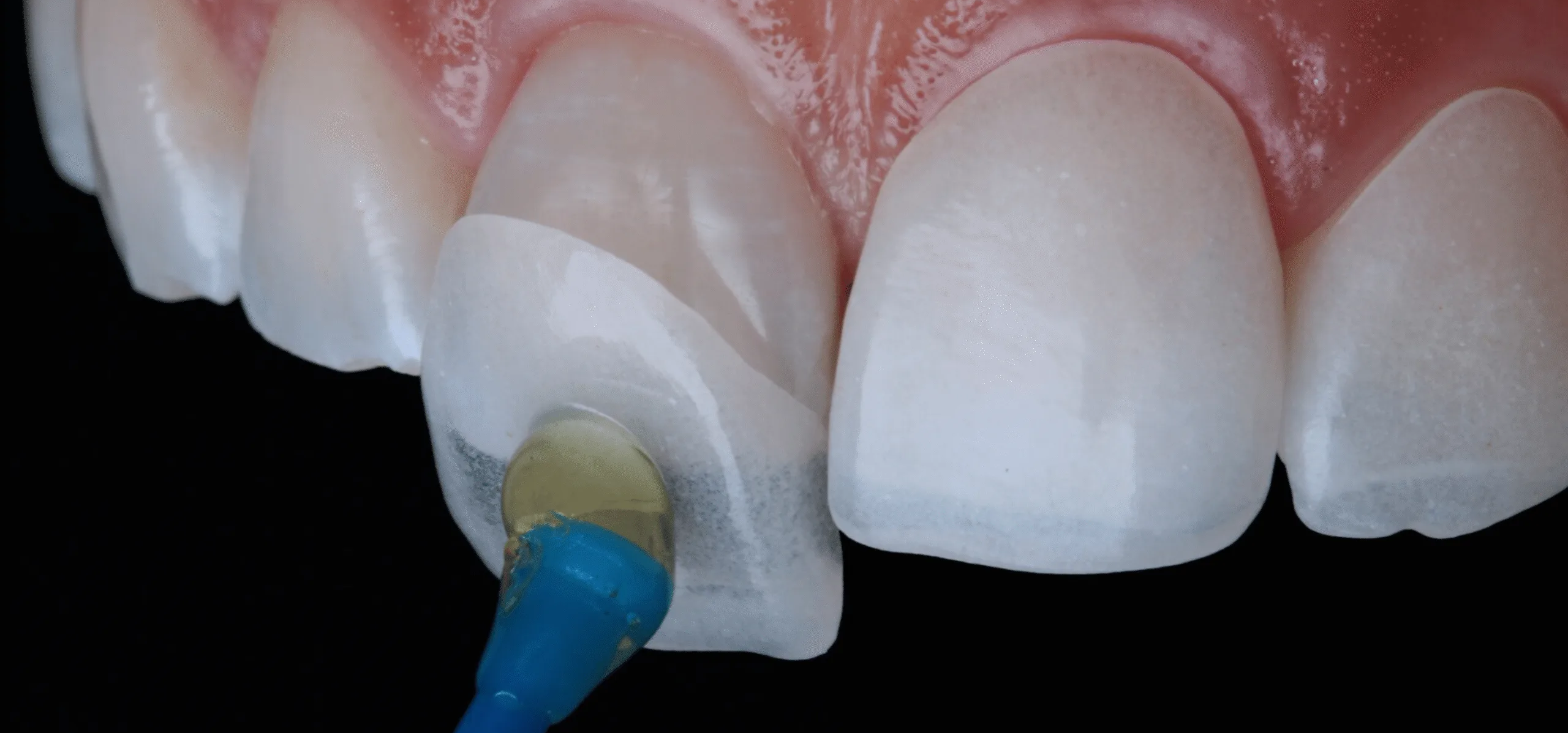 Dental Veneers